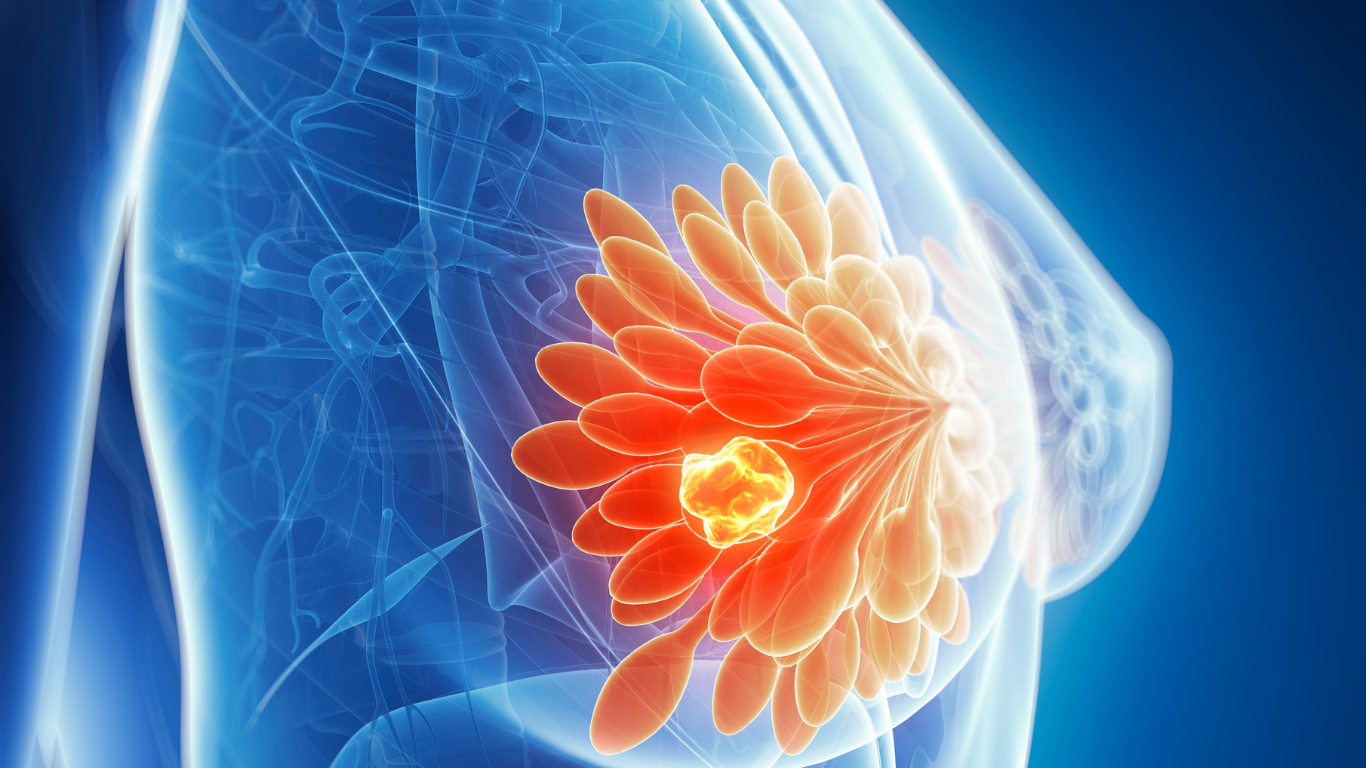 Inteligencia Artificial utilizada en la detección del cáncer de mama