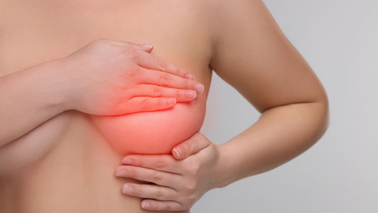 Persona sujetando uno de sus senos con ambas manos, mostrando una zona enrojecida que sugiere dolor, inflamación o la posible presencia de un bulto. La imagen transmite una molestia mamaria o una condición relacionada con el pecho, como mastitis, sensibilidad, inflamación o un posible bulto mamario.